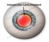 IOL Intraocular Lens Implant Treatment Mumbai India, Intraocular Lenses, IOL Intraocular Lens Implant Treatment Delhi Hospital